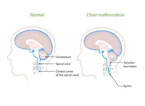 Chiari Malformation Hart Garner Md