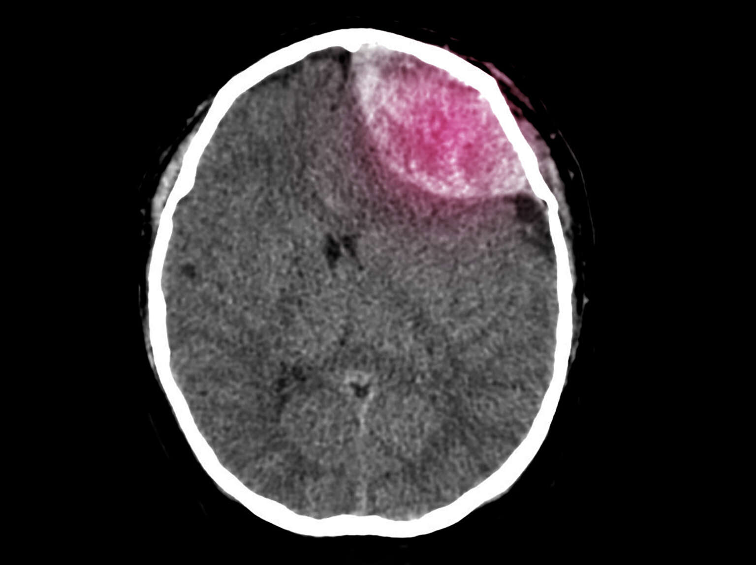 Craniotomy MRI