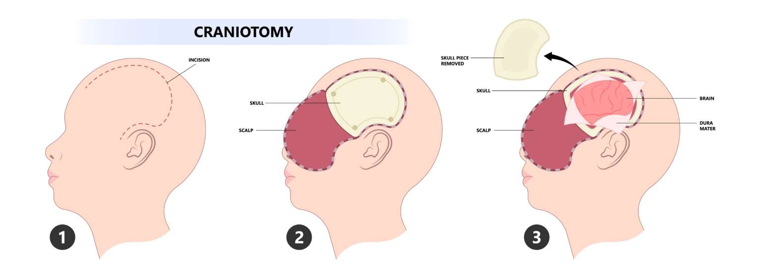 Craniotomy diagram