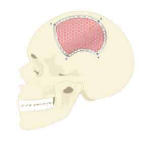 Decompressive Craniectomy Image