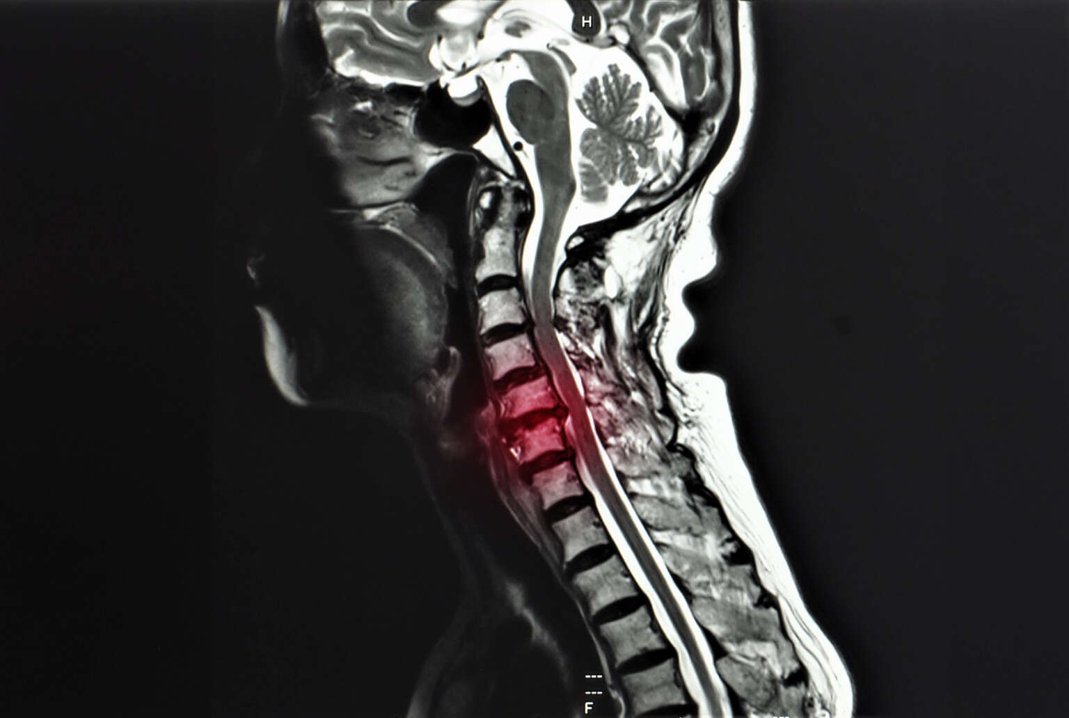 Radiculopathy image