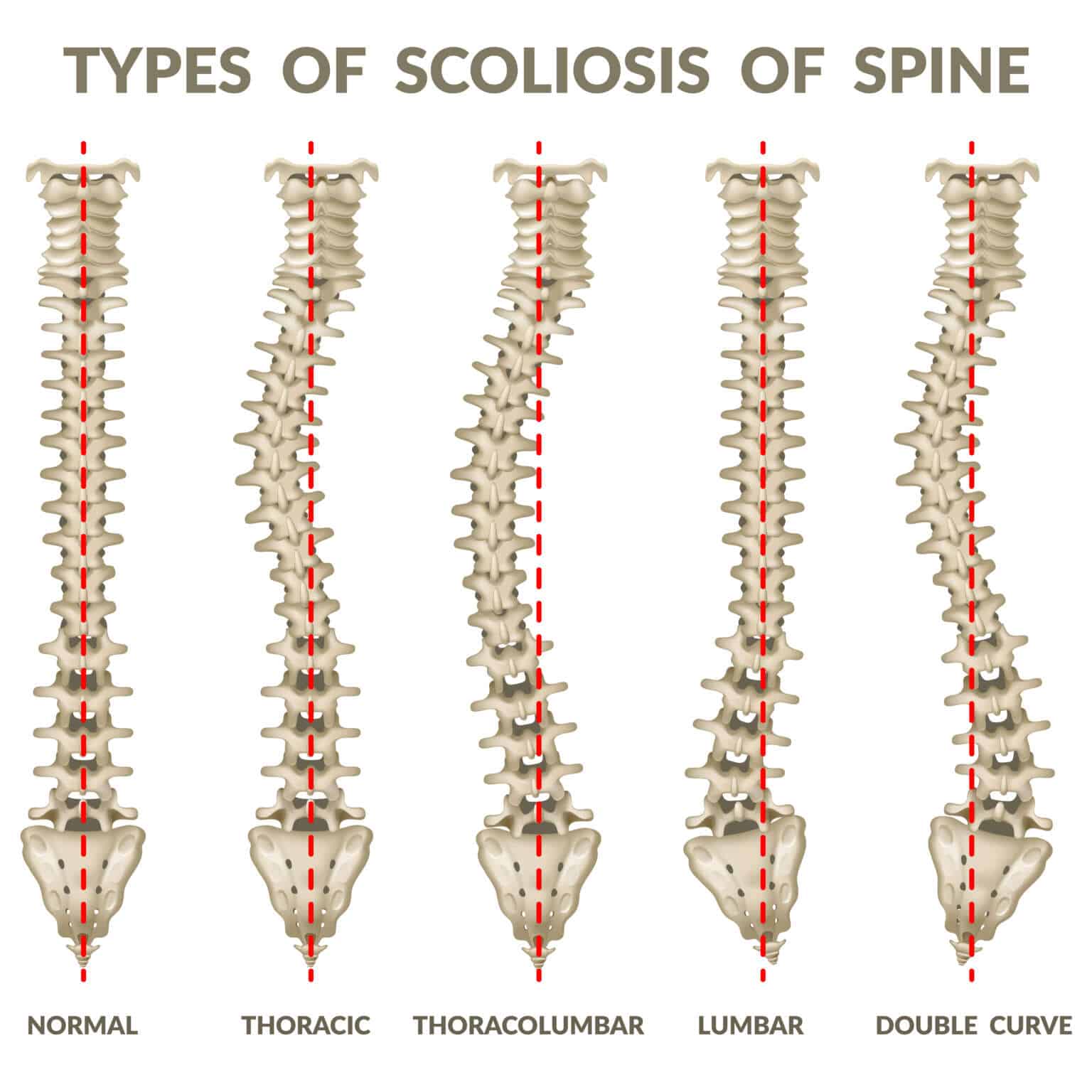 Scoliosis image