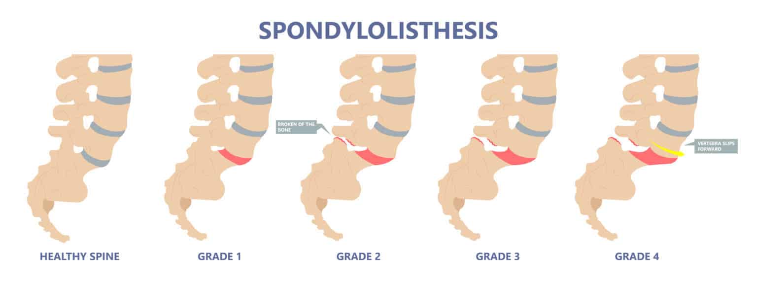 Spondylolisthesis