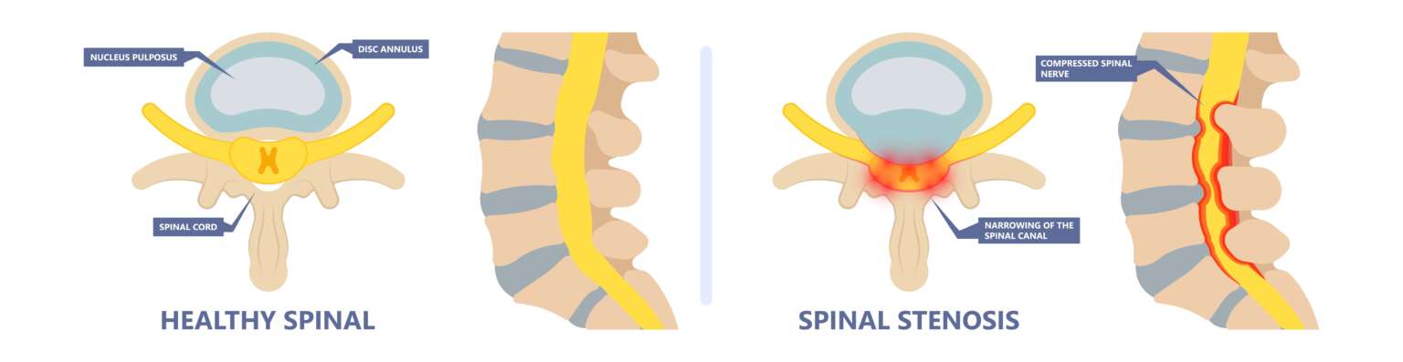 Spinal stenosis image