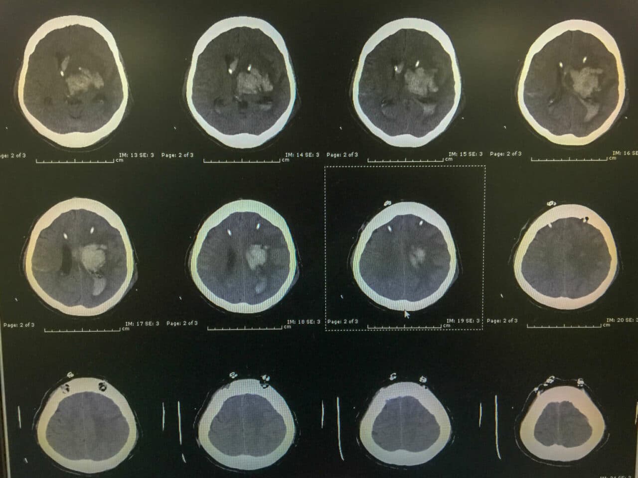 Ventriculostomy - Hart Garner, MD - Minnesota Spinal Neurosurgeon