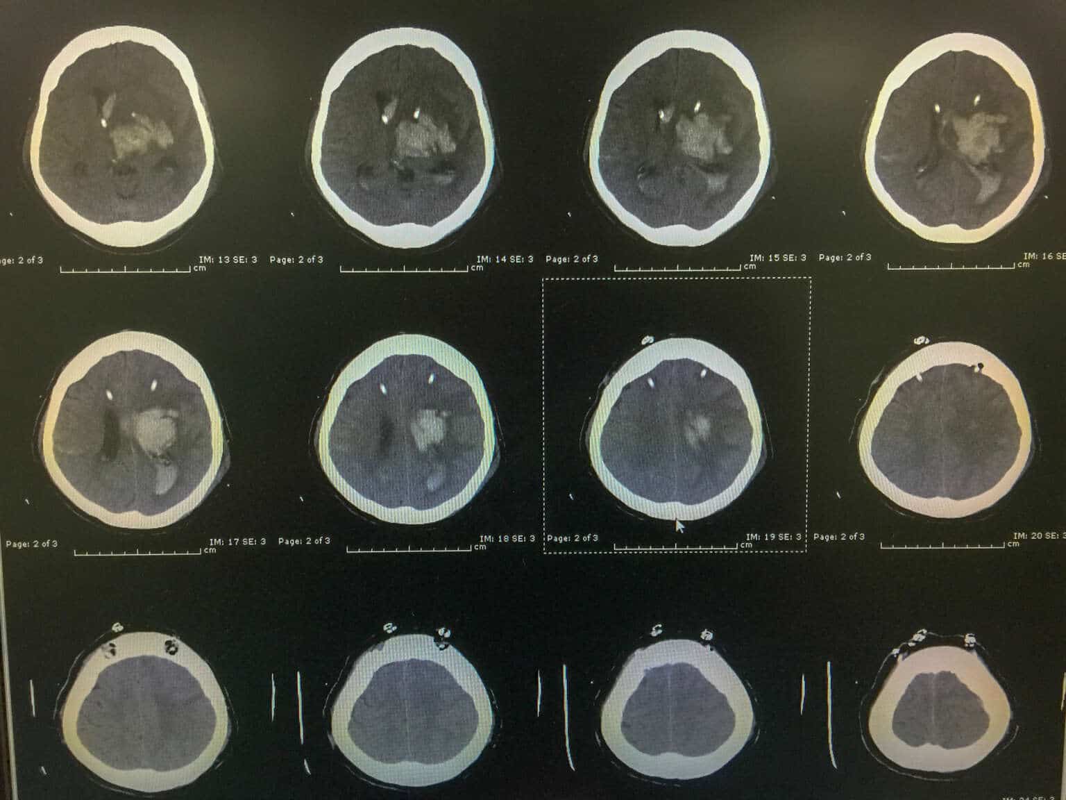 Ventriculostomy