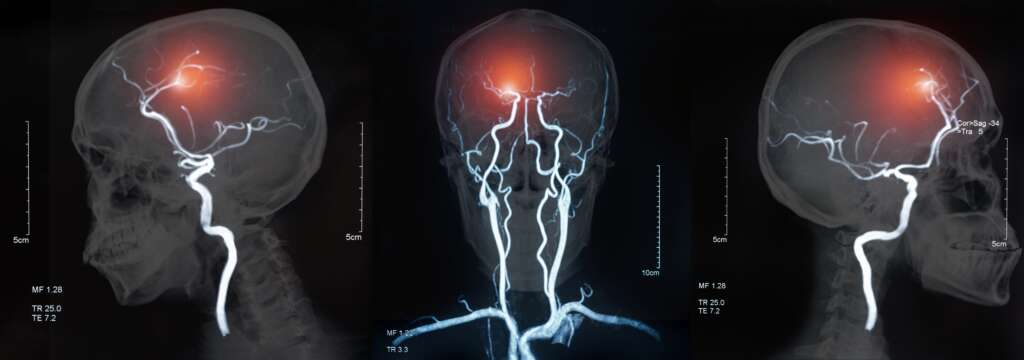 Cerebrovascular disease and stroke image