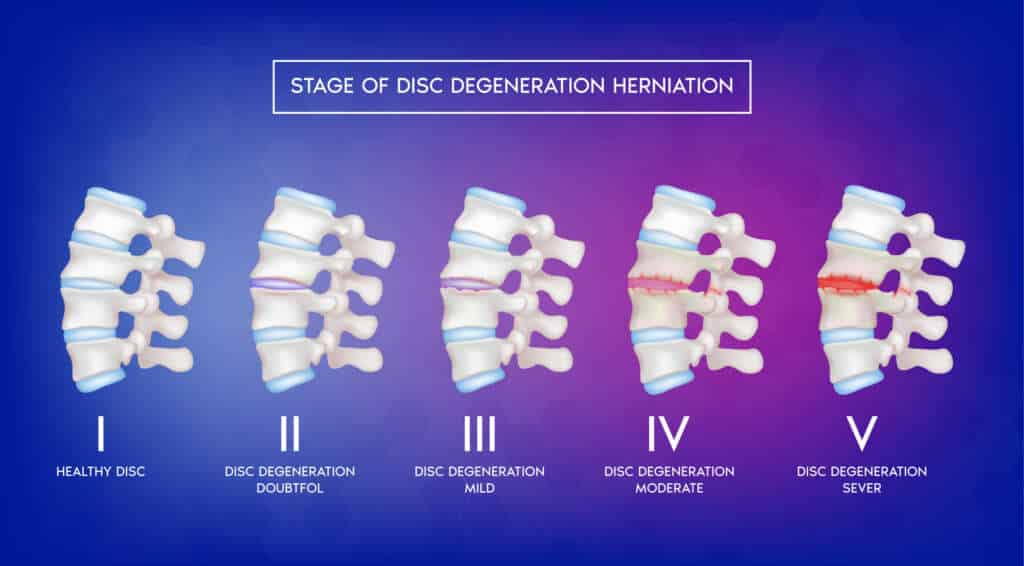 Stages of Spinal Disc Degeneration