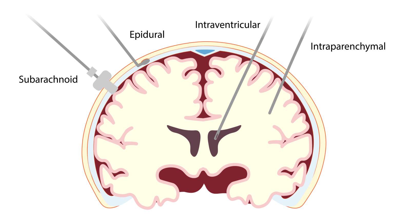 Intracranial Pressure Monitoring image