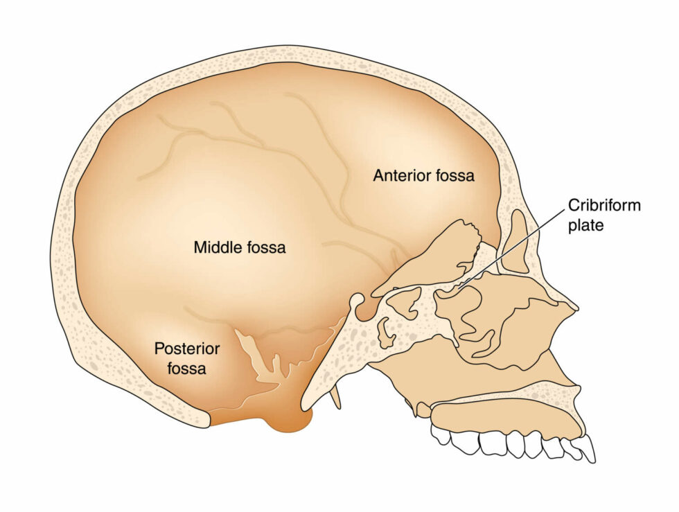 Middle Fossa Craniotomy Hart Garner Md Minnesota Spinal Neurosurgeon