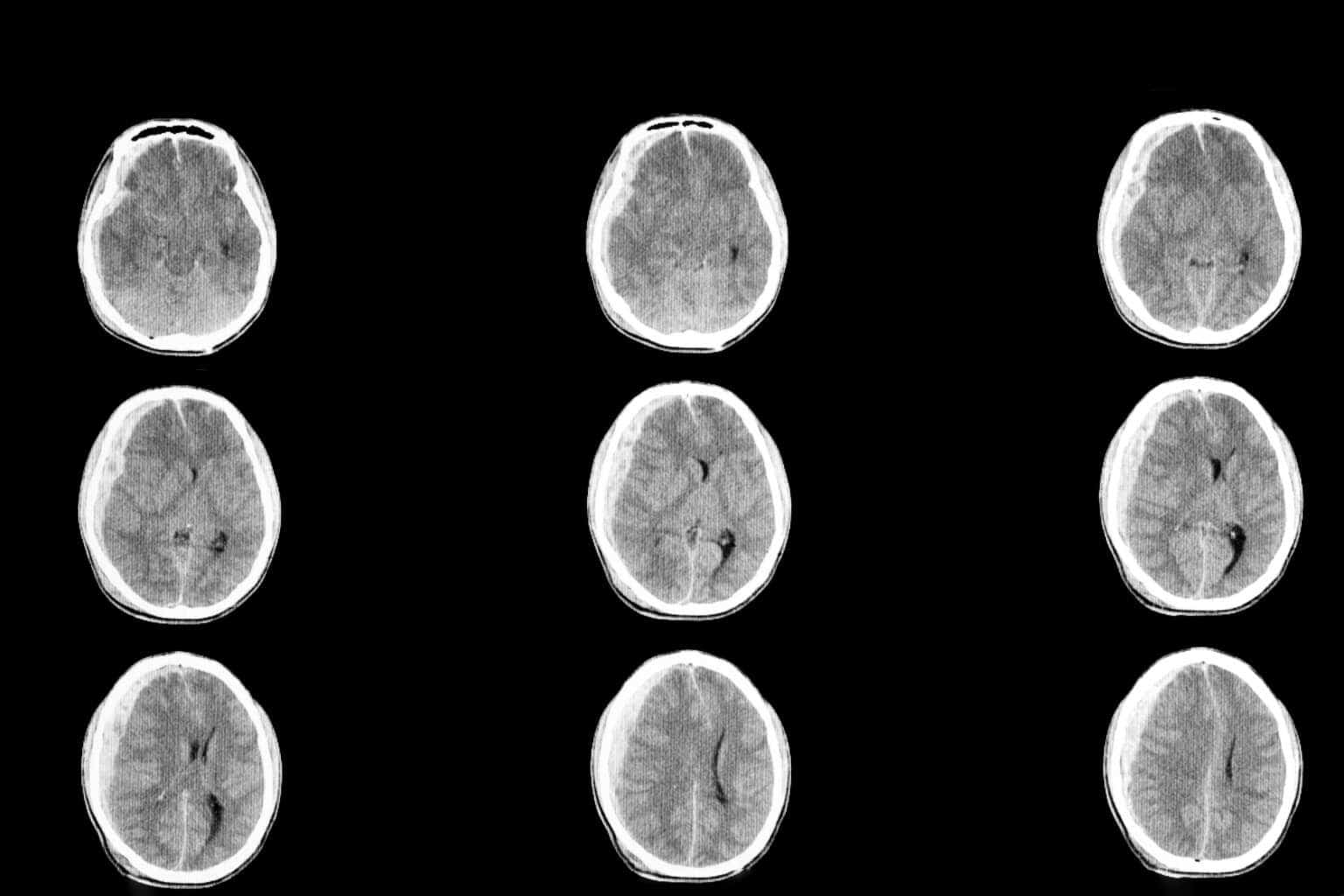 Posterior Fossa Craniotomy MRI