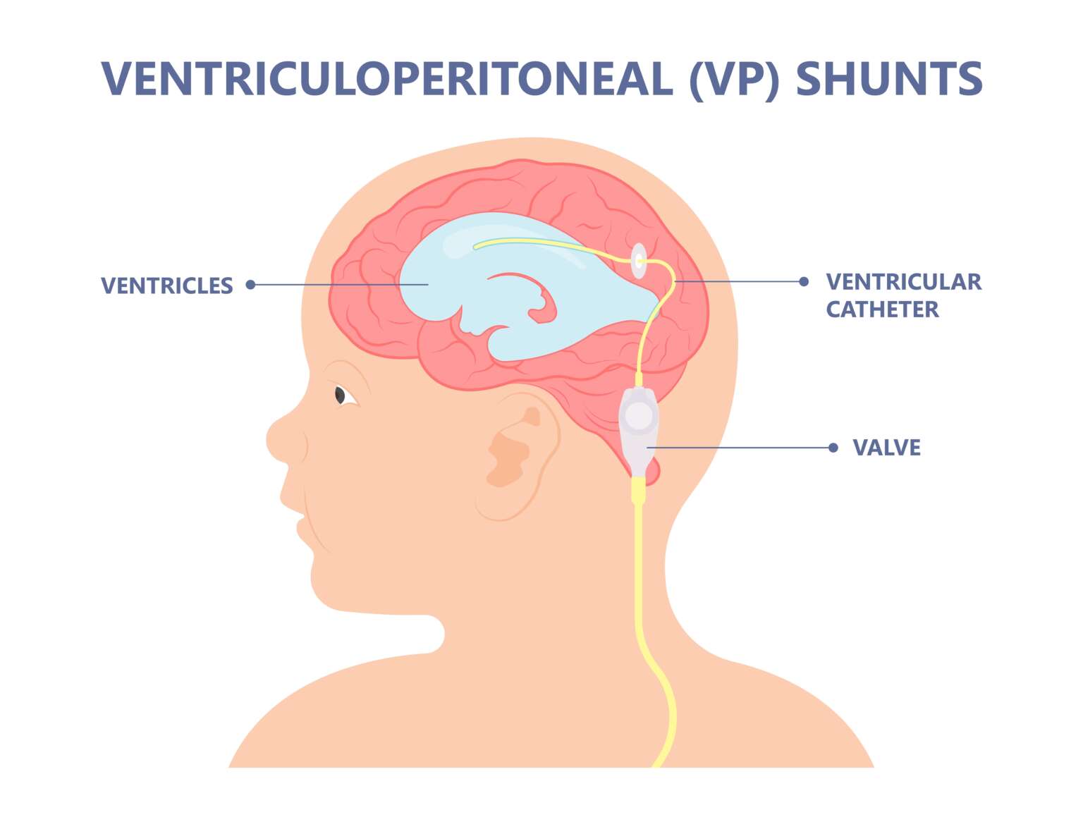 Ventriculoperitoneal Shunt Hart Garner Md 9268